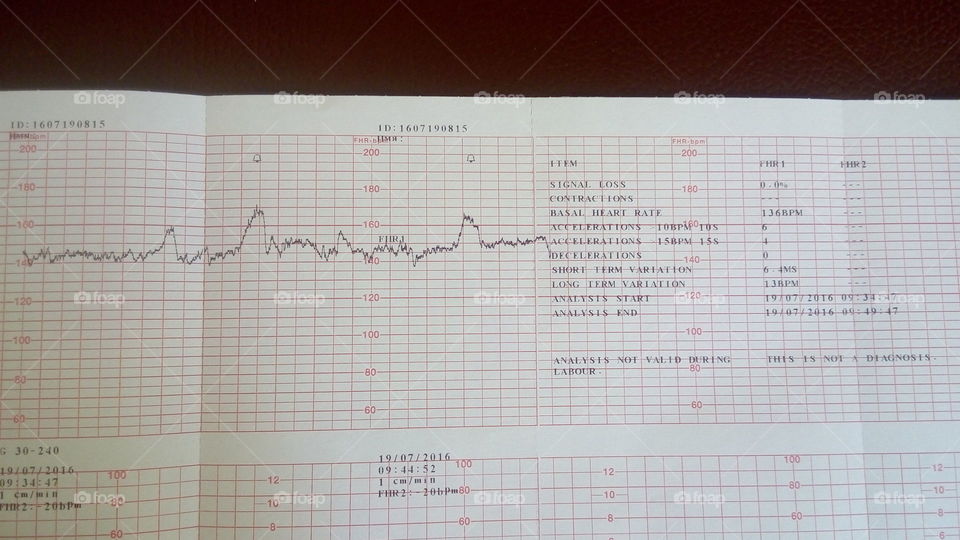 fetal CTG.Heartbeat