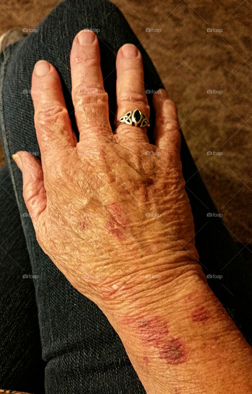 Aging Hands Bruise Easily!
